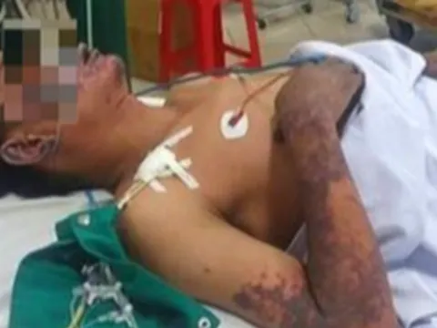 Nhiễm liên cầu khuẩn lợn, người đàn ông bán thịt nguy kịch