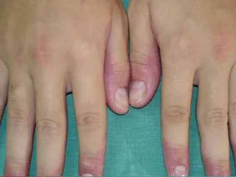 Nên làm gì khi bị cước tay, chân vào mùa đông?