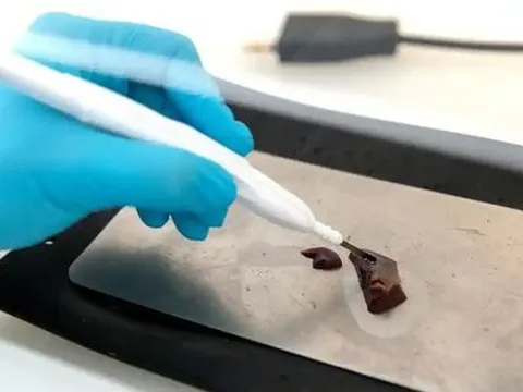 Đột phá: iDao có thể phát hiện ung thư trong vài giây