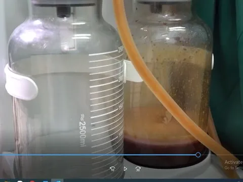 Cô gái bị chất làm đẹp ăn tới tận xương chậu