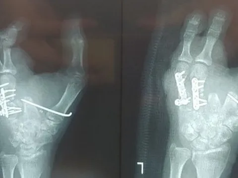 Lắp ngón chân thành ngón tay cho bệnh nhân