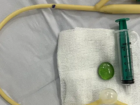 Gắp sỏi dị vật nằm ở thực quản bé trai 18 tháng tuổi