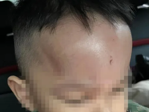 Đà Nẵng: Cơ quan chức năng xác minh vụ việc phụ huynh phản ánh trẻ bị bạo hành