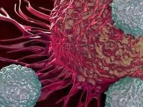 4 dấu hiệu ở bụng có thể cảm nhận, nhìn thấy bằng mắt thường đang cảnh báo về sự phát triển của tế bào ung thư