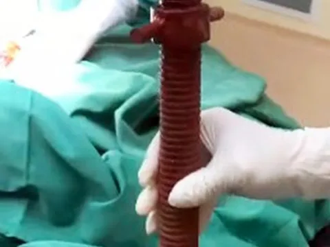 Cứu nam thanh niên bị thanh sắt đâm xuyên cổ