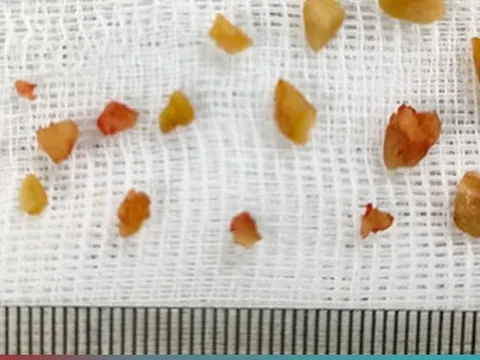 Hóc hạt lạc khiến 3 trẻ suy hô hấp nặng do bít tắc đường thở