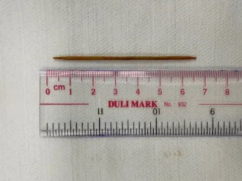 Thói quen khiến người đàn ông bị tăm tre nhọn đâm xuyên tĩnh mạch chủ