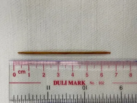 Người đàn ông bị thủng ruột non vì thói quen nhiều người Việt thường làm