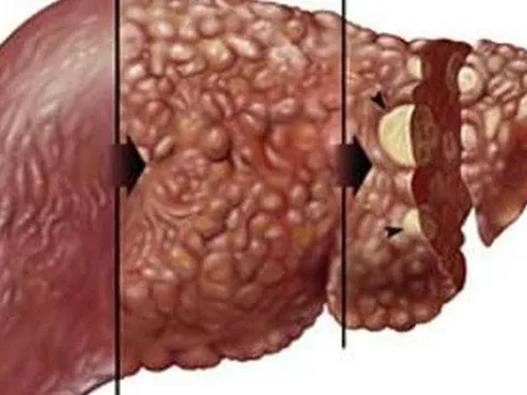 Bác sĩ đưa bí kíp bảo vệ lá gan ngày Tết