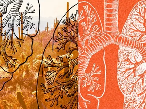 Dịch bệnh kỳ lạ đang lan rộng khiến nhiều người Mỹ bị ốm kéo dài