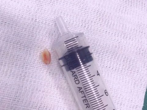 Nghệ An: Cứu sống trẻ 18 tháng tuổi ăn hạt lạc bị mắc trong khí quản