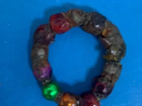 Bé trai bị thủng ruột do nuốt... 14 viên bi nam châm