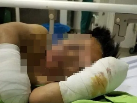 Bé trai 8 tuổi bị thương, mất 2 bàn tay sau tiếng nổ