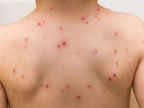 Thời tiết thay đổi, cẩn trọng bệnh sởi, thủy đậu ở trẻ nhỏ