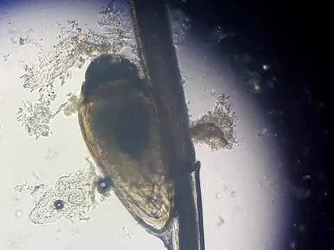 Rận ký sinh chi chít ở nách người đàn ông suốt 2 tháng