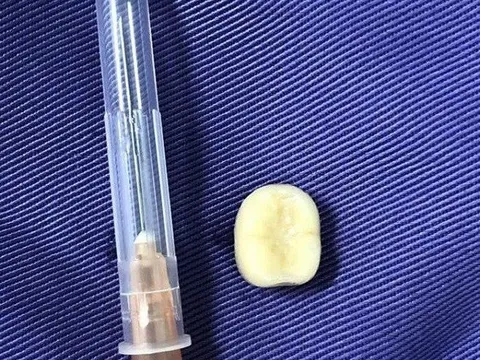 Sau cơn ho, người đàn ông nhập viện vì răng giả trôi xuống phế quản