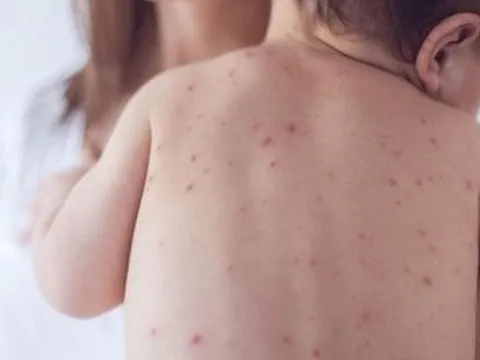 Đắk Lắk ghi nhận 2 ổ dịch thủy đậu mới