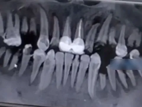 Chàng trai 23 tuổi răng bị ăn mòn, gãy gần hết cả hàm vì loại đồ uống giới trẻ không ai là không thích