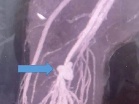 Bé trai suýt bị cắt cụt chân vì vết thương 'bé tí'