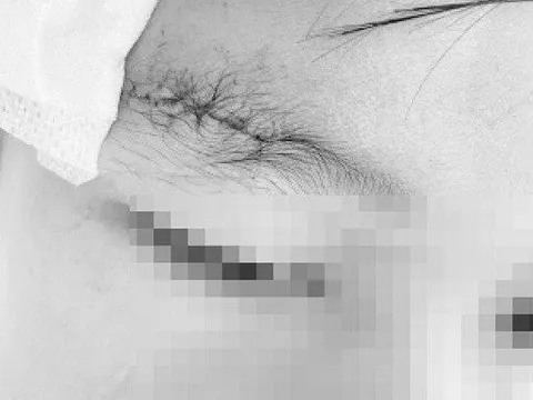 Nghịch súng hơi, bé trai 10 tuổi bị đạn găm vào xương sọ