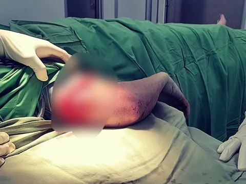 Khánh Hòa: Tiêu hủy con chó cắn du khách nước ngoài nhập viện