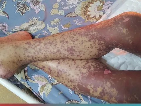 Hoại tử da toàn thân sau khi uống thuốc