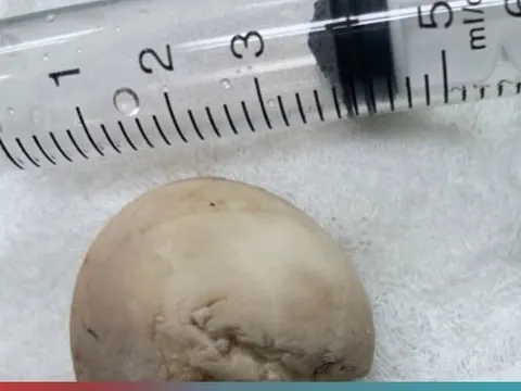 Người đàn ông phải nhập viện cấp cứu sau ăn trứng vịt lộn