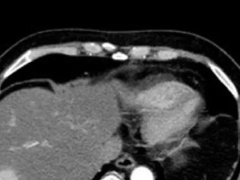 Phát hiện 'sát thủ' ung thư gan khi đi khám tim mạch