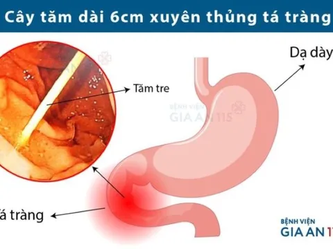 Hoảng hồn bệnh nhân bị tăm đâm thủng ruột mà không hay biết