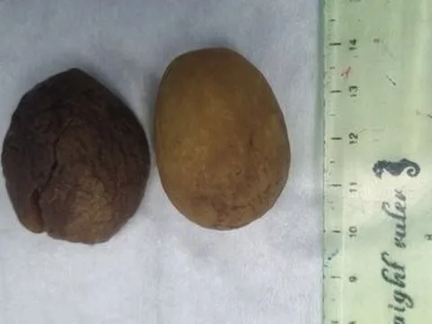 Kịp thời cứu sống cụ ông bị tắc ruột do nuốt quả chà là