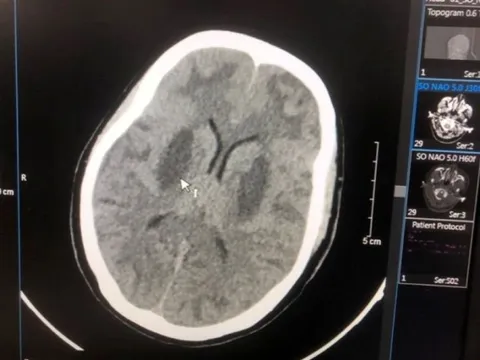 Bắc Ninh: 37 công nhân nhiễm độc methanol, ghi nhận ca tử vong, mù mắt