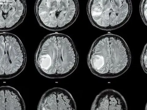 Đầu bé 1 tuổi tự nhiên to lên, bác sĩ lấy ra cả một bào thai trong não