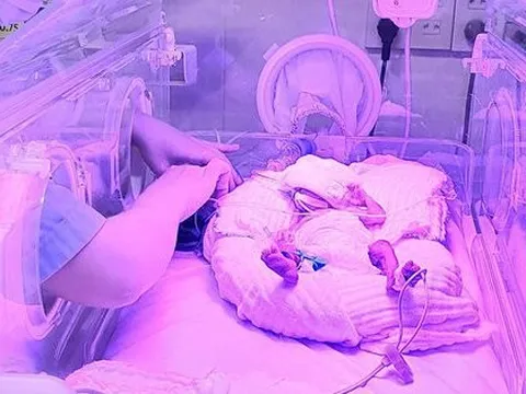 3 tháng diệu kỳ với bé gái sinh non ở tuần 24, nặng vỏn vẹn 700g