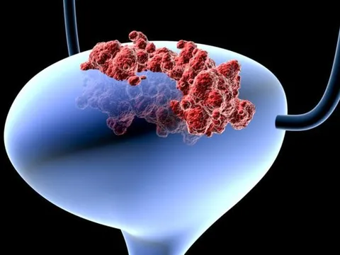 Đột phá: Xét nghiệm nước tiểu dự báo ung thư 12 năm trước khi phát bệnh