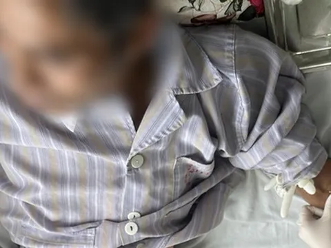 Hai người nguy kịch vì nhiễm liên cầu lợn