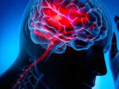 8 việc giúp bạn ngăn chặn đột quỵ 'tấn công', áp dụng sớm để giảm rủi ro tử vong