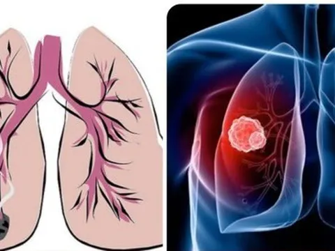 9 dấu hiệu ung thư phổi giai đoạn đầu