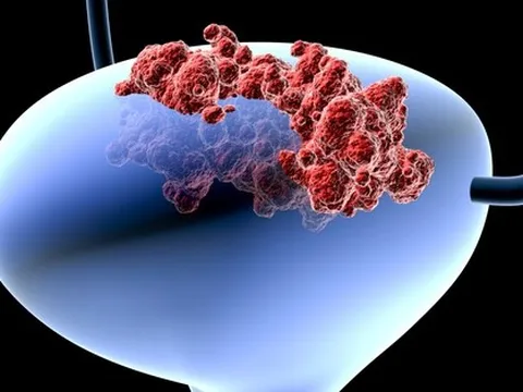 80% người bị ung thư bàng quang đều có biểu hiện sớm này