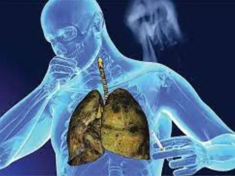 Những dấu hiệu sớm của ung thư phổi giai đoạn đầu