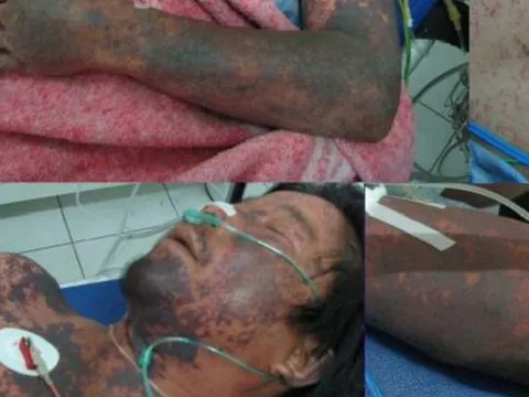 Người đàn ông bị viêm màng não mủ do ăn tiết canh ngan bán ở chợ