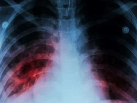 WHO: Một bệnh cũ trỗi dậy sau 20 năm, đang gây tử vong nhiều hơn COVID-19