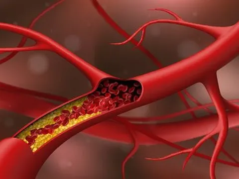 Cholesterol cao: Thêm nguyên nhân bất ngờ, không liên quan ăn uống