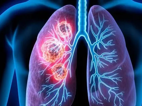 Dấu hiệu ở ngón tay báo hiệu ung thư phổi đã “gõ cửa”