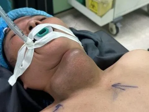 Người phụ nữ bị áp xe tuyến giáp vì tự đắp thuốc nam