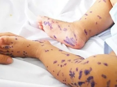 Sai lầm hàng nghìn người vẫn mắc khi chăm sóc, điều trị bệnh thủy đậu