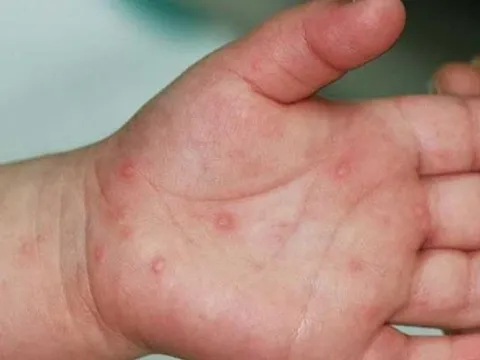 Ca mắc tay chân miệng tại Hà Nội gia tăng