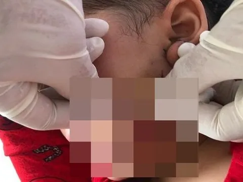 Bé trai 3 tuổi ở Cà Mau bị chó dại cắn đứt nửa bên lưỡi