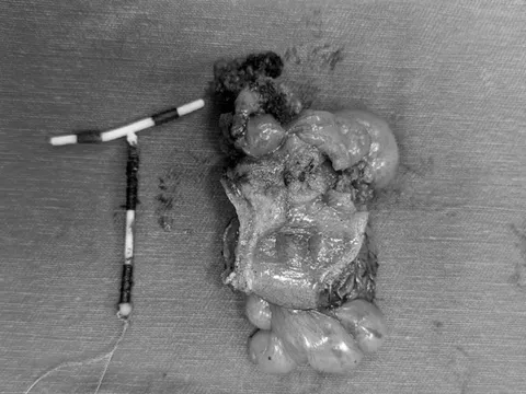 Dụng cụ tránh thai đi lạc chỗ khiến người phụ nữ bị thủng đại tràng