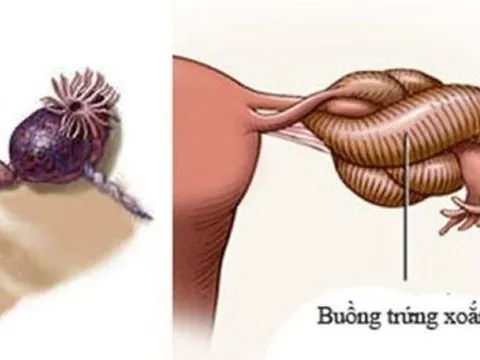 Bé gái hơn 1 tuổi ở Nghệ An phải cắt bỏ buồng trứng
