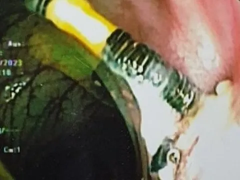 Người phụ nữ bị vòng tránh thai nằm gọn trong đại tràng sau 3 năm đặt vòng